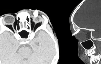 Ha un gonfiore sotto l’occhio, in ospedale scoprono che ha un dente nella palpebra: lo strano caso in India